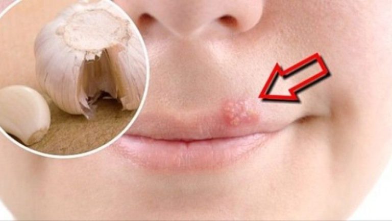 Get Rid of Herpes By Using a Simple Trick