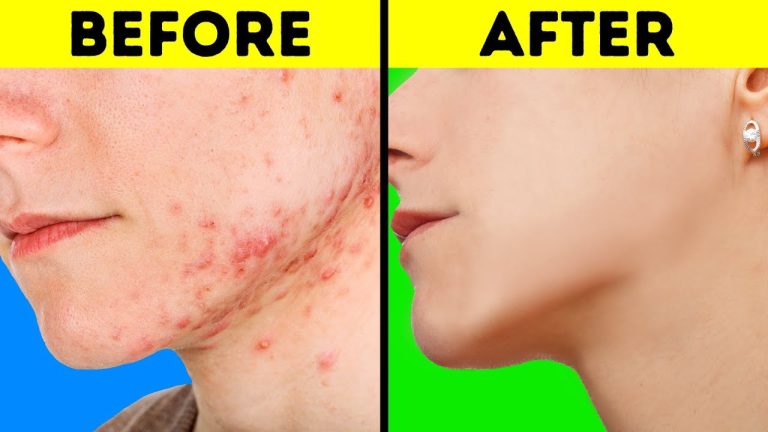 Natural Hacks For Your Skin Problems