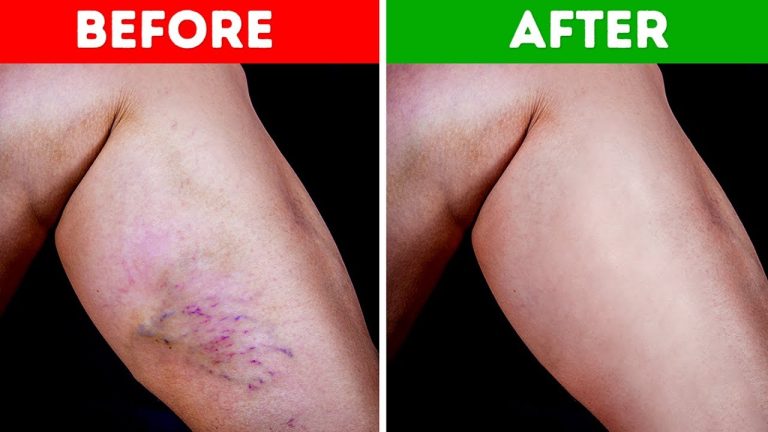 Get Rid Of Spider Veins In These 7 Natural Methods