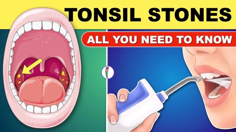 Tips On Removing Tonsil Stones With Relief !
