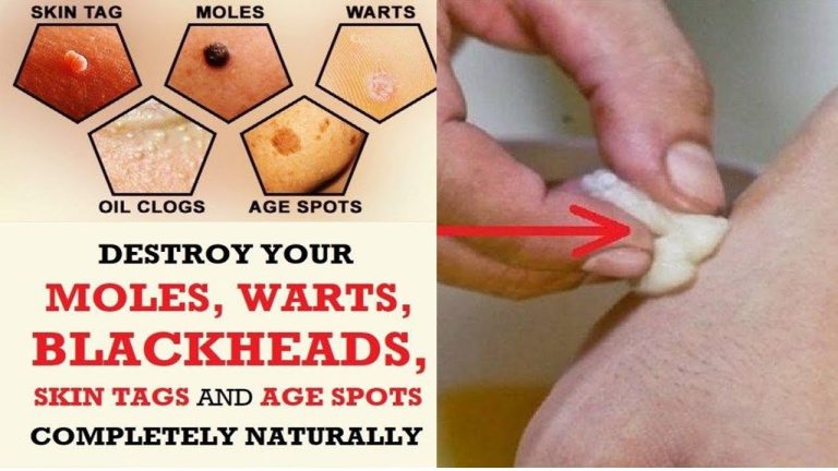 How to Get Rid of Warts, Moles, Age Spots and Skin Tag Using Natural Remedies